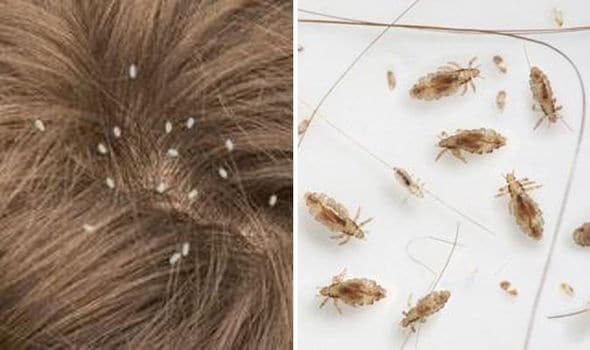 Head Lice Symptoms Causes  Homeopathic Treatments  WelcomeCure