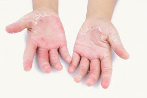The ‘Total Body’ Management of Psoriasis