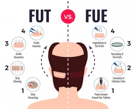 FUE vs FUT