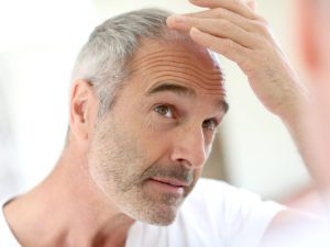 Male Hair Loss