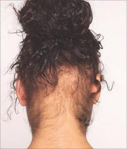 traction-alopecia