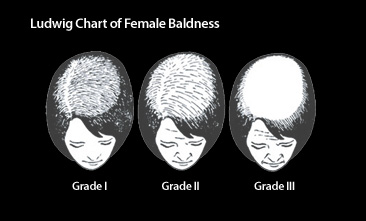 female-hair-loss-post