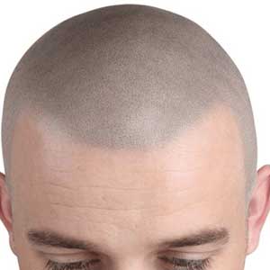 scalp-micropigmentation