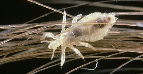 head lice