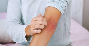 About Psoriasis – Facts and Tips