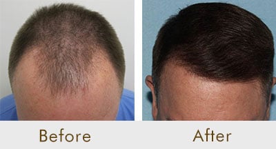 SmartGraft-before-after-1